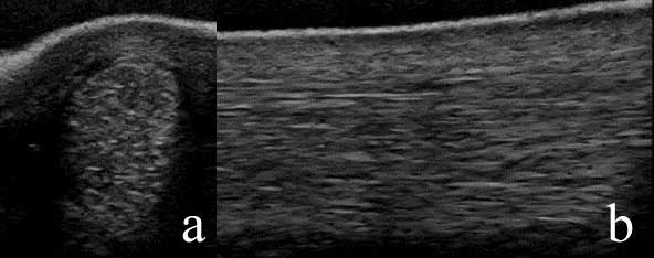 Figure 3. Transverse (3a) and longitudinal (3b; proximal is to the left) images of the medial branch of the suspensory ligament of the right hindlimb of the horse in Figure 2. It shows enlargement of the ligament (cross-sectional area 1.2cm2), a mild diffuse decrease in echogenicity and reduction in the proportion of long, linear, parallel echos in the longitudinal image.