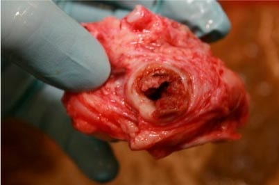 Figure 1. Arteritis and thrombosis of the root of the cranial mesenteric artery as a result of infection with Strongylus vulgaris