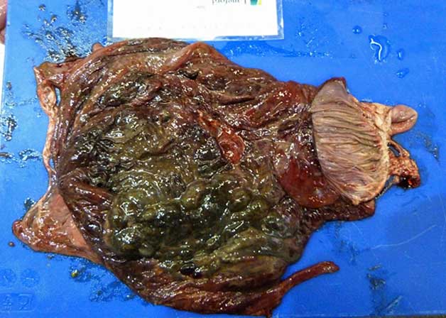 Figure 6. Marked darkening and emphysema of the abomasal mucosa is commonly seen.