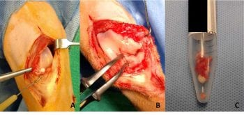 Figure 2. Intraoperative photographs demonstrating (A) a small free-floating mineralised body encountered on entering the joint through a medial arthrotomy, (B) significant mineralisation of the medial meniscus and (C) the quantity of mineralised material removed from the joint at surgery completion.