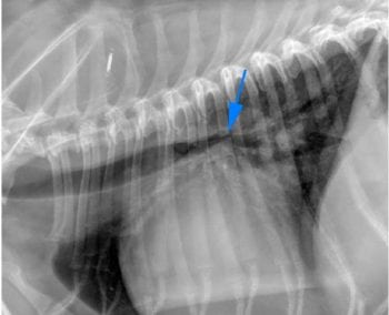 Figure 1. Left mainstem bronchus compression at the carina (blue arrow) secondary to left atrial cardiomegaly.