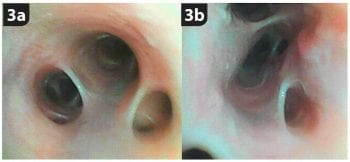 Figure 3. Normal lower airways (3a) and dynamic lower airway collapse due to bronchomalacia (3b).