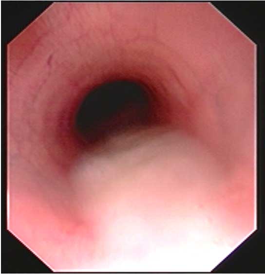 Figure 2. Endoscopic appearance of mucopus accumulating within the trachea at the level of the thoracic inlet.