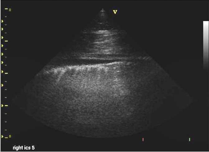 Figure 4. Thoracic ultrasonography demonstrating an increased volume of pleural fluid.