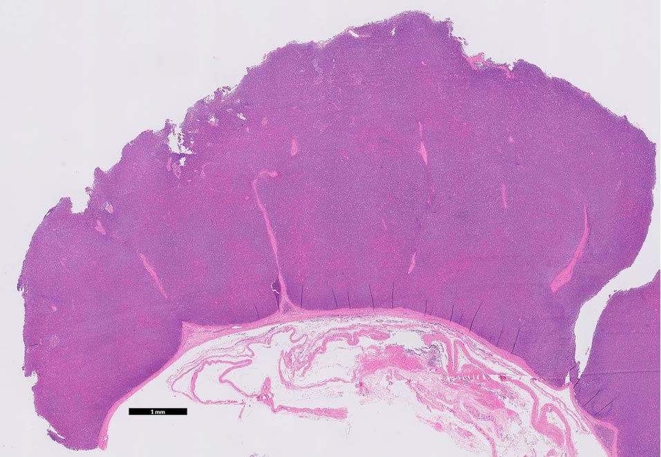 Juvenile bovine lymphoma: low-power photomicrograph of a lymph node with lack of normal architecture and flat sheets of neoplastic lymphocytes.