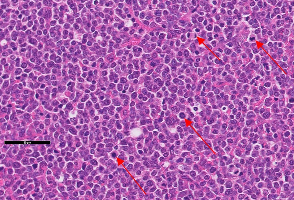 Juvenile bovine lymphoma: high-power photomicrograph of numerous neoplastic lymphocytes (some arrowed).