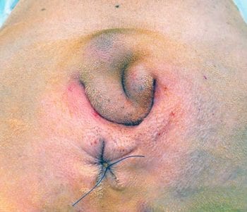 Figure 3. Surgical preparation includes hair clipping of the perineal area, tail base and tail folds. A purse string suture is placed around the anus. Image: AHT.