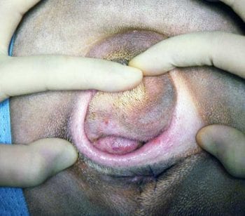 Figure 4. Screw-tail often creates redundant and deep skin folds around the base of the tail. The skin-to-skin contact leads to cutaneous inflammation (skin fold dermatitis or intertrigo) as the two opposing surfaces rub against each other, causing localised friction and abrasion. Image: AHT.