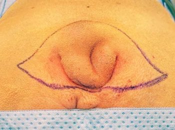 Figure 5. A horizontal elliptical skin incision is made around the entire tail base. Drawing the planned surgical incision with a surgical sterile marker pen is helpful for surgical planning. Image: AHT.
