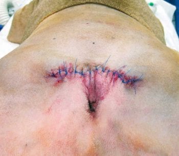 Figure 7. Surgical site following caudectomy. Image: AHT