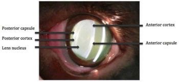 Figure 1. A slit lamp image of a lens showing the capsule, cortex and nucleus.