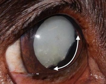 Figure 9. Lens-induced uveitis. Note the endothelial keratic percipitates (black arrow) and the ectropion iridis (white arrow).