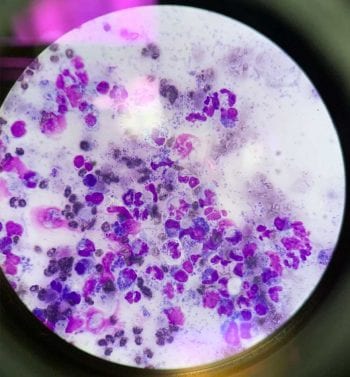 Figure 1. A variety of intracellular bacteria could be seen, confirming a septic peritonitis.