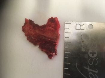 A bony sequestrum, a common postoperative complication following extraction of madibular cheek teeth.