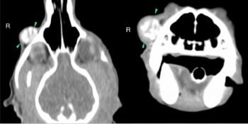 Figure 2. A CT scan showing ossified/calcified mass in contact with the skull (green arrows).