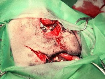 Figure 5. A 3D implant plated in place, with the “lip flap” mobilised.