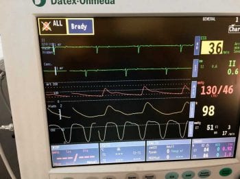Figure 4. Arterial pressure waveform and a visible dicrotic notch. The dicrotic notch is generated at the time of aortic valve closure when, normally, a small backflow of blood into the ventricles arises. The slope of the systolic upstroke gives an indication of myocardial contractility.