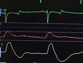 Figure 5. Poor myocardial contractility is suspected when a shallow systolic upstroke is present. Changes in the pulse pressure across the ventilatory cycle can be indicative of the detrimental effect positive pressure ventilation has on venous return to the heart. Pulse pressure variation can be appreciated by viewing sequential arterial waveforms. The effect of positive pressure ventilation on the cardiovascular system is more pronounced when hypovolaemia is present.