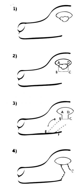 Figure 6. A diagram of the lip-to-lid procedure.