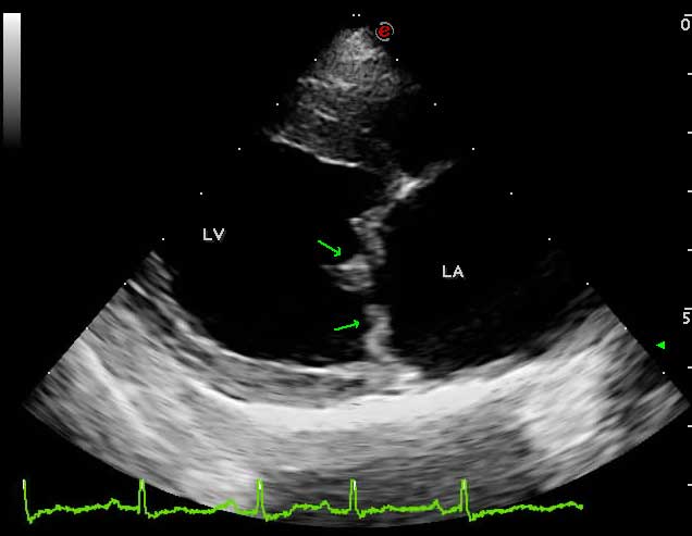 Figure 2. Echocardiographic image obtained from the right parasternal long axis four-chamber view showing distorted, nodular and thickened mitral valve leaflets, which tend to bulge towards the left atrial lumen (green arrows). Key: LA = left atrium; LV = left ventricle.