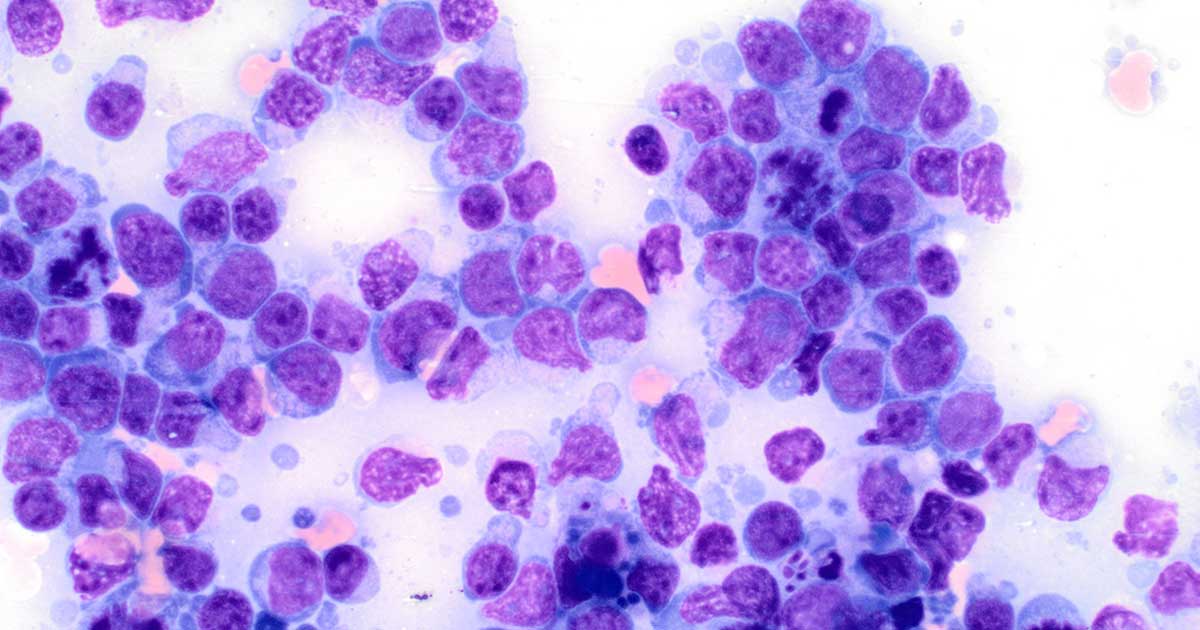 Figure 1. Large cell high grade lymphoma (50× oil immersion).