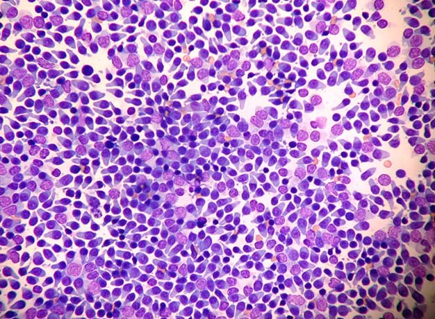 Figure 2. Lower grade T-cell lymphoma (50× oil immersion).