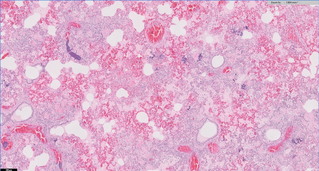 Pulmonary thromboembolism