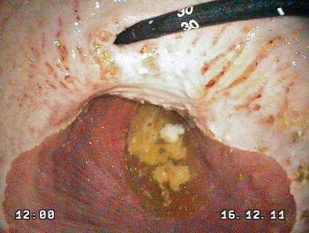 Figure 3. Endoscopic appearance of equine squamous gastric disease.