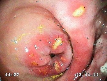 Figure 4. Endoscopic appearance of equine glandular gastric disease.