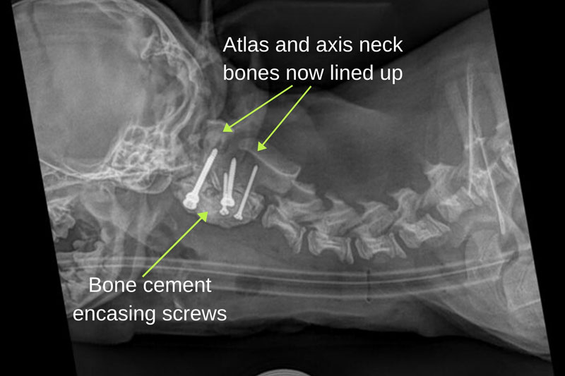 The x-ray after surgery shows the atlas and axis bones in line, stabilised with bone screws and cement.