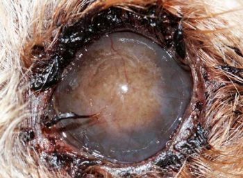 Figure 1. A patient with blepharitis and keratitis related to severe keratoconjunctivtis sicca. Note the dark crusty ocular discharge, corneal fibrosis, pigmentation and vascularisation. Cataract surgery was not feasible due to the corneal pathology in this patient.