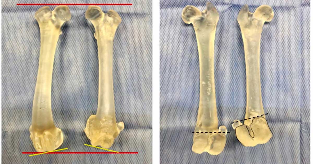 Figure 1. 3D prints of the femurs of a dog that developed a complex angular limb deformity following a physeal fracture as a puppy. Bone replicas of both the intact and affected femurs were printed to enable a deeper understanding of what surgical procedures may be necessary. Left. Craniocaudal view of both femurs. The left femur is significantly shorter than the intact right femur (red lines) and displays clear distal femoral varus (yellow line). Right. Caudocranial view of both femurs. The caudal aspect of the left femoral condyles have been contoured for clarity. The medial condyle is displaced proximally and the lateral condyle has rotated internally.