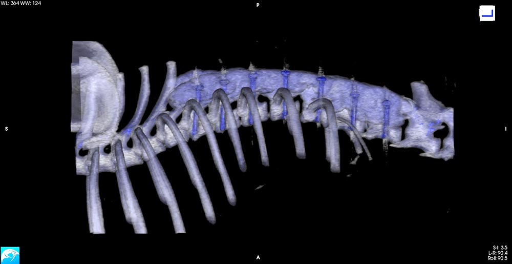 The screws are cemented together to form a rigid construct to protect the spinal cord.