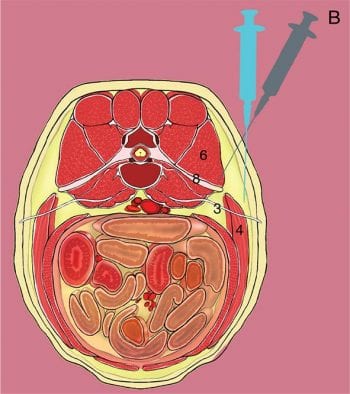 Figure 1. An illustration of the lateral cutaneous femoral nerve block technique. 3 = lateral cutaneous femoral nerve; 4 = abdominal wall; 6 = epaxial muscles; 8 = seventh lumbar transverse process.