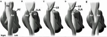 Figure 3. Vascular abnormalities. 3a. Normal. 3b. Persistent right aortic arch (PRAA). 3c. PRAA and left subclavian artery. 3d. PRAA, left ligamentum arteriosum and aberrant subclavian artery (two compression sites). 3e. Double aortic arch.