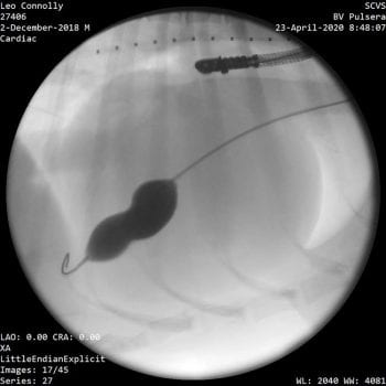 A balloon valvuloplasty was performed to alleviate Leo’s symptoms.