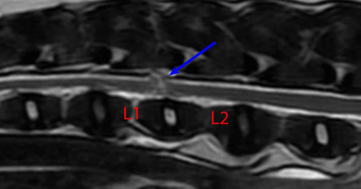 T2-weighted MRI sagittal view showing the acute lesion of the spinal cord between L1 and L2 (blue arrow).