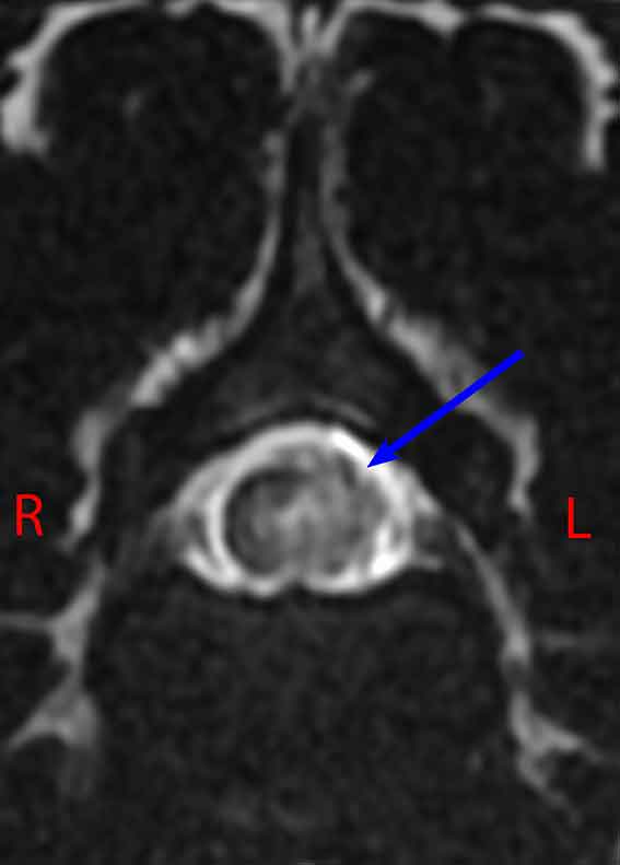 T-weighted MRI transverse section showing a focal left‑sided myelopathy, likely oedema (blue arrow).