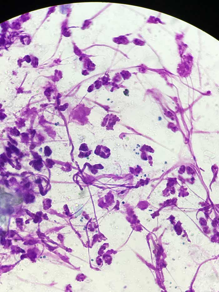 Figure 5. Photomicrograph of cocci and neutrophils in a direct impression smear from a dog with a papular to pustular eruption.