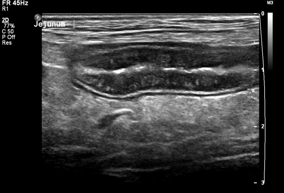 Figure 1. Ultrasonographic image of the jejunum in long-axis showing multiple hyperechoic striations in the mucosa. Biopsies revealed lymphoplasmacytic inflammation and a diagnosis of inflammatory bowel disease was made.