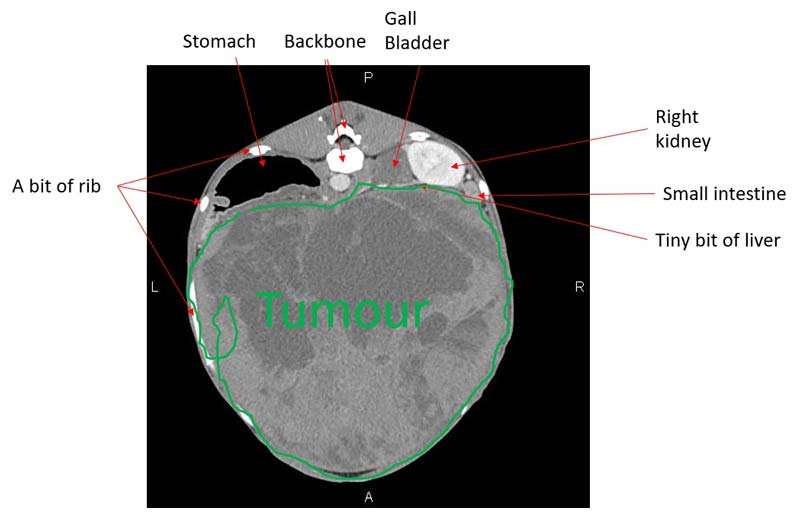 Sky's CT scan confirming the presence of a huge mass