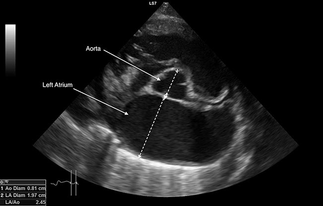 Figure 6. Left atrial to left aortic diameter in a dog with congestive heart failure.