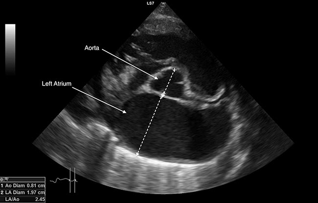 Figure 6. Left atrial to left aortic diameter in a dog with congestive heart failure.