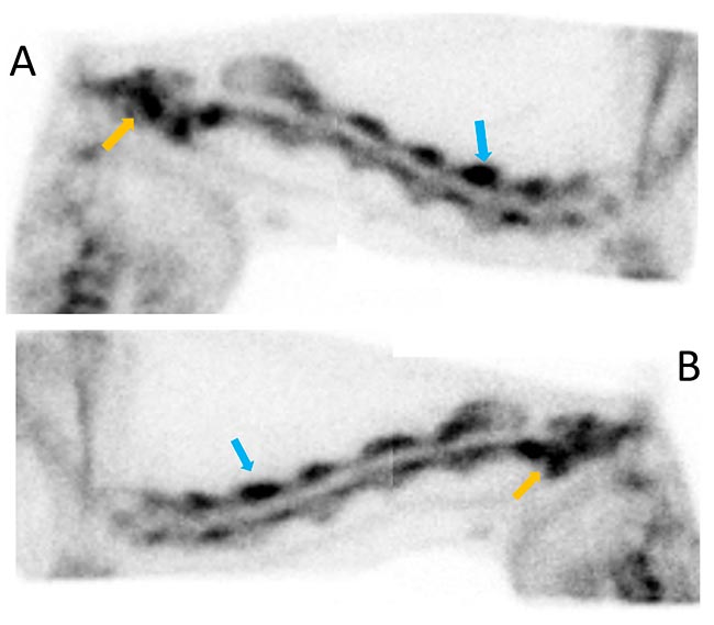 Figure 2. Nuclear scintigraphy images of a horse’s neck. The arrows point to areas of increased radiopharmaceutical uptake suggestive of active bone inflammation.