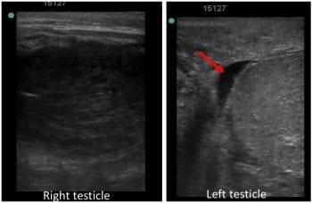 Figure 2. Comparison of echogenicity of the testicular parenchyma of the right and left testicles. Note a small amount of hypoechogenic free fluid within the vaginal tunic on the left side (red arrow).