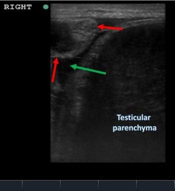 Figure 3. An ultrasound image from the right scrotum: note the heterogenous hypoechogenic testicular parenchyma, free fluid in the vaginal tunic (green arrow) and a dilated non-motile partially fluid-filled structure adjacent to the testicle (red arrows).
