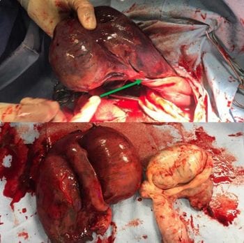 Figure 5. (Top) An intraoperative photograph showing the torsed portion of the spermatic cord (green arrow) with healthy pink tissue proximal to the twist. (Bottom) A photo showing size and colour of the torsed testicle (left) compared to the normal testicle (right). Note the difference in size of the epididymii.
