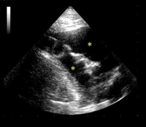 Figure 3b. Point-of-care ultrasound image. Hypoechoic areas (green stars) consistent with pleural effusion.