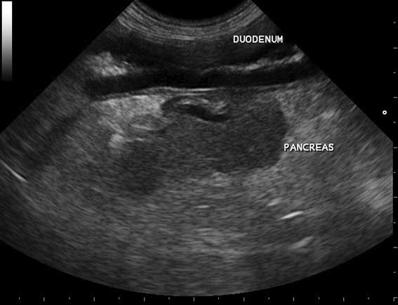 Figure 4. Hypoechoic pancreas with hyperechoic surrounding mesentery typical of acute pancreatitis; neoplasia cannot be eliminated from this appearance.