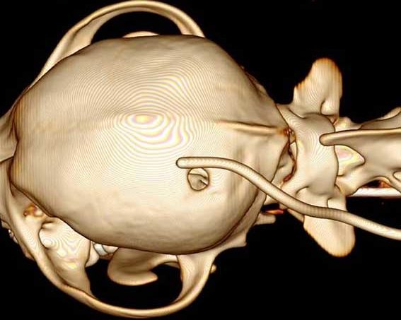 Figure 10. A 3D CT-reconstructed image showing migration of the ventricular portion of the ventriculoperitoneal shunt outside the skull.